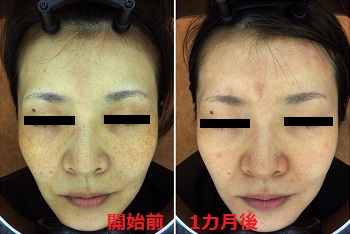 ゼオスキンセラピューティック症例 シミ そばかす エステサロンツツイ 大阪 心斎橋 のブログ