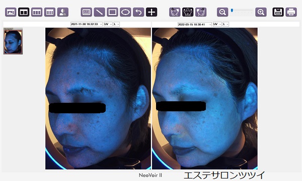 自分の肌が見たい！肌年齢はいくつ？肌診断機導入しました☆画像