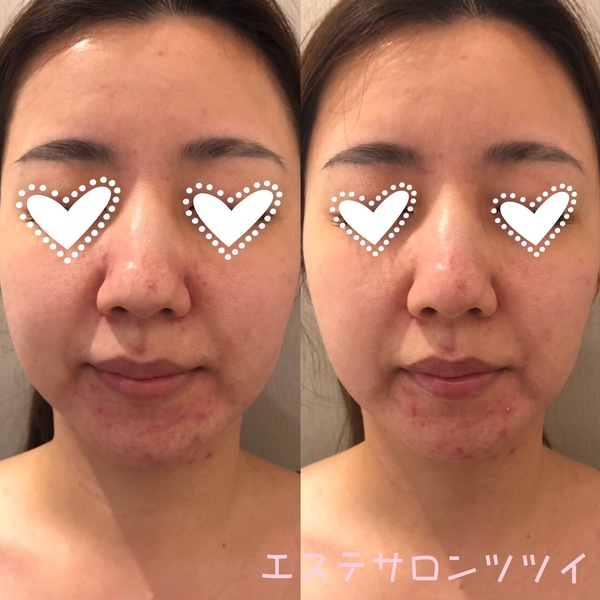 角栓詰まりがごっそりとれるトリートメント!!毛穴洗浄ピーリングの効果について - エステサロンツツイ(大阪・心斎橋)のブログ
