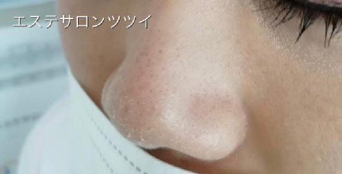 反応 レチノール