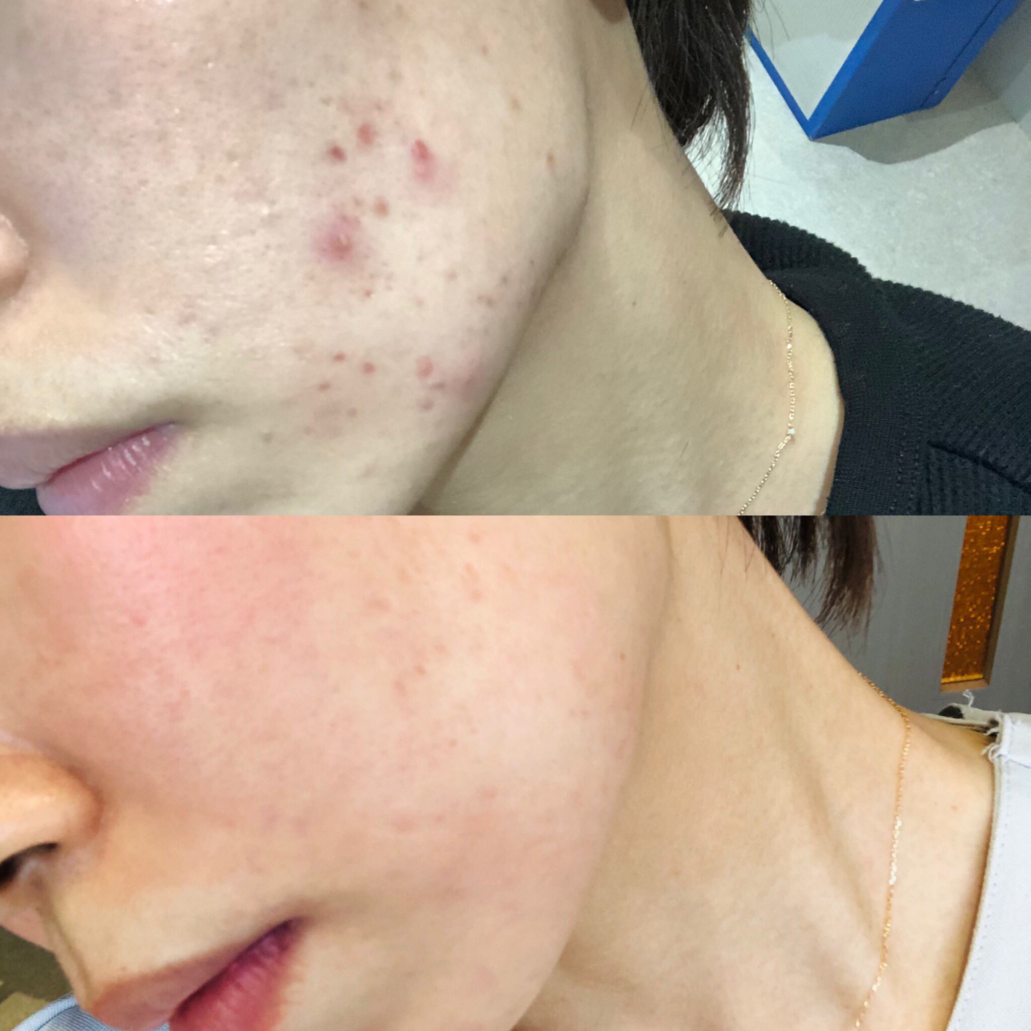 ニキビに効果実感体験談：ニキビ症例とニキビに効果的なエンビロン