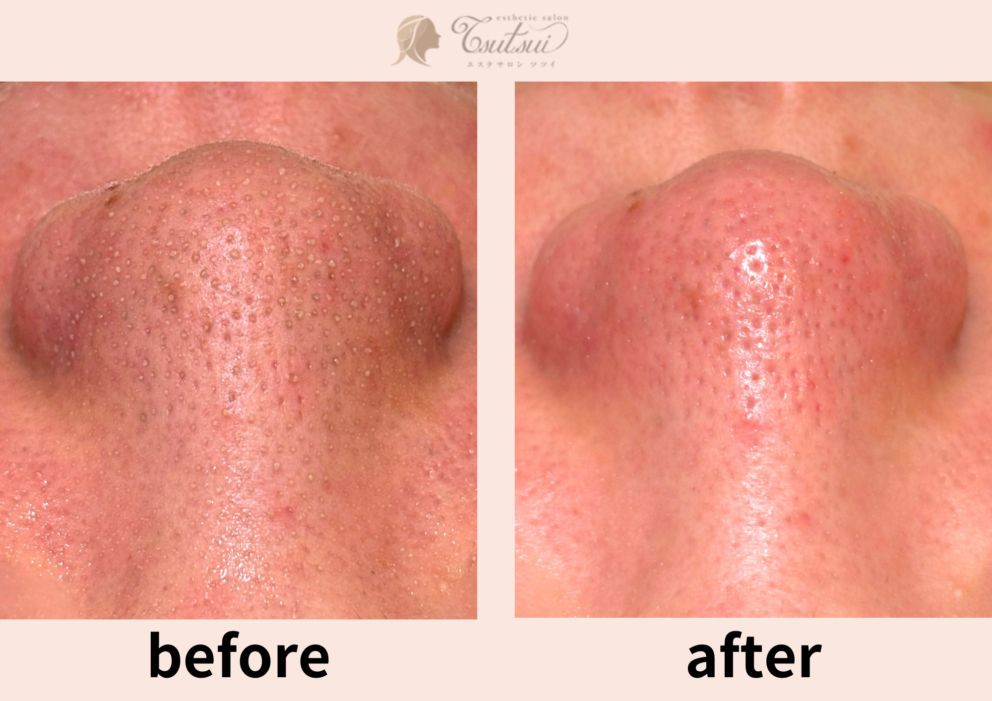 大阪・心斎橋】毛穴の黒ずみ・角栓に効果抜群！高濃度水素洗浄